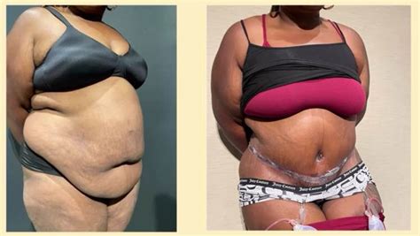 The Fleur de lis Tummy Tuck: Sculpting a Beautiful Midsection