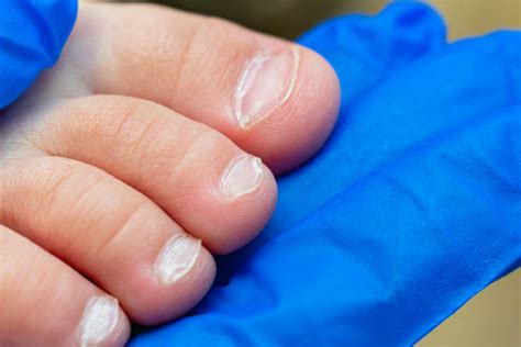 320+ Curved Toenails Stock Photos, Pictures & Royalty-Free Images - iStock
