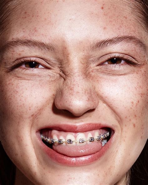 Пин от пользователя Yogita Manchanda на доске Braces photoshoot в 2024 г | Ортодонтия, Брекеты