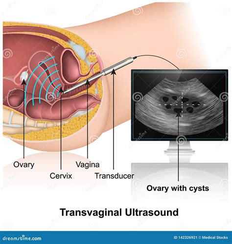 Transvaginal Ultrasound Checkup 3d Medical Illustration on White