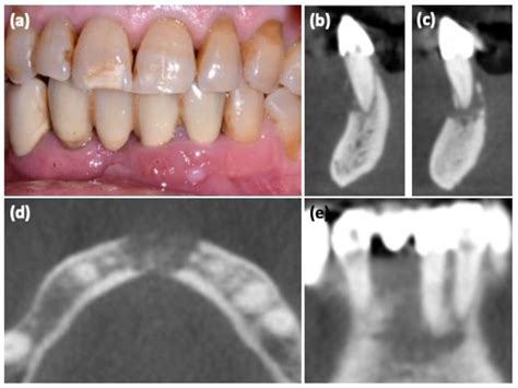 Onset of MRONJ in Breast Cancer Patients after Switching from Low to