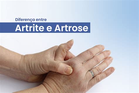 O Que É Artrite E Artrose - Artrite x Artrose - Saiba a diferença entre as doenças, seus sintomas ...