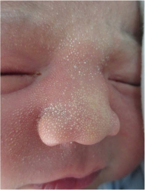 Neonatal Dermatologic Findings in Uruguay: Epidemiology and