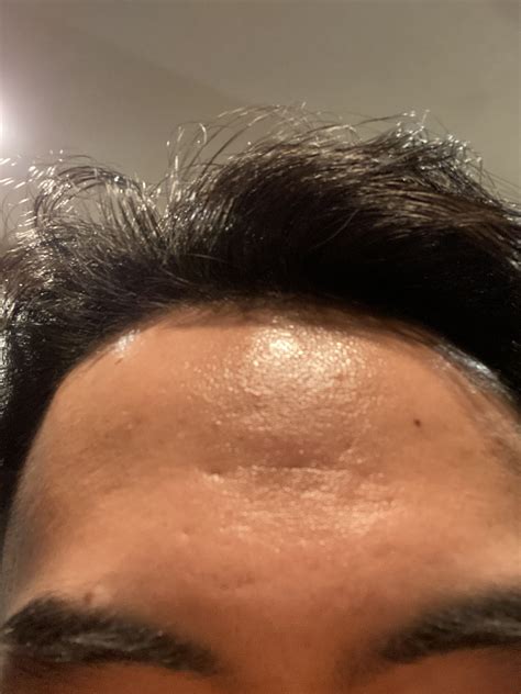 Forehead scars – Scar treatments – Acne.org Forum
