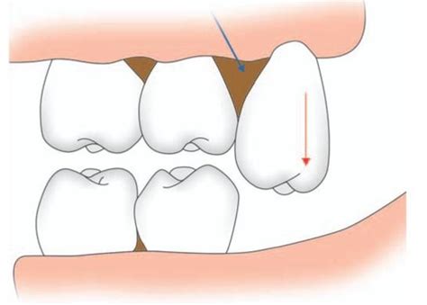 Postoperative Care and Instructions | Pocket Dentistry