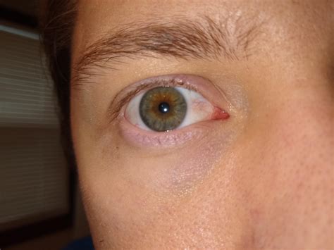 eye redness probably caused by dry eye. how concerned should I be? : r/eyetriage