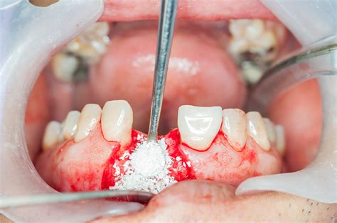 Tooth Implant Bone Graft