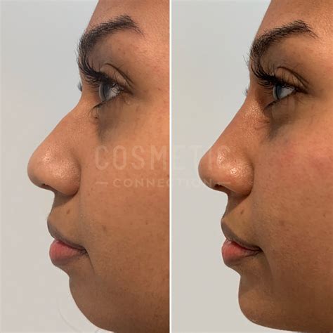 Nose Job Before And After Profile