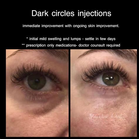 Light Headed And Dark Circles Under Eyes at Laura Stanley blog