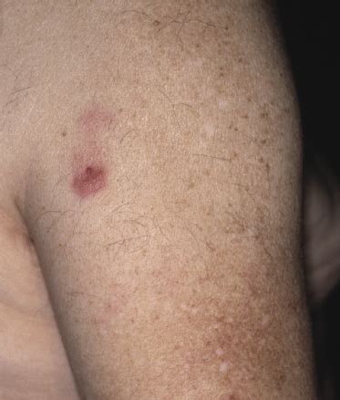 11: Cutaneous Follicle Center Lymphoma | Plastic Surgery Key