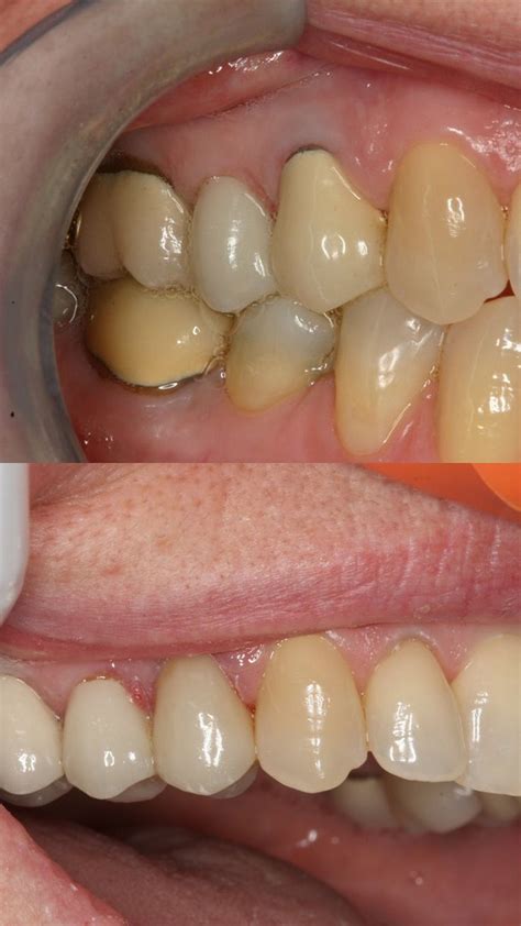 Porcelain fused to metal pfm repair cosmedent inc – Artofit