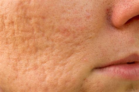 What You Can Do About Acne Scars
