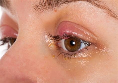 Swollen Eyelid Permanent Treatment at Lindsay Johnson blog