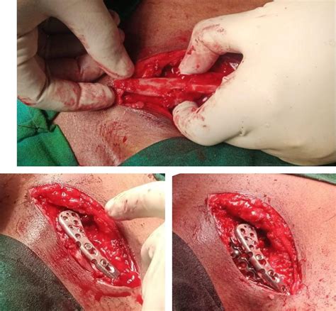 Surgical Treatment of a Non-union of Medial End Clavicle Fracture with