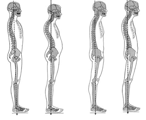 ck clinic standing posture