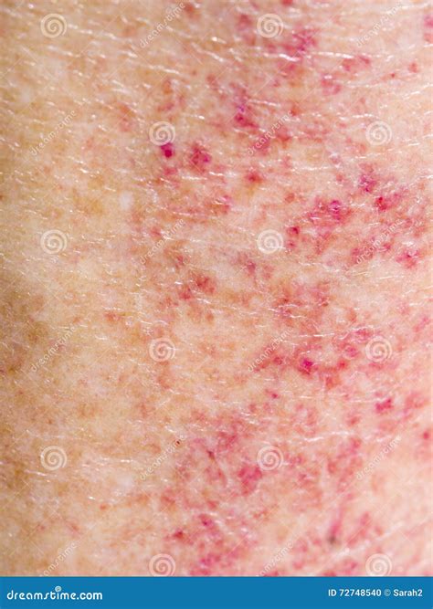 Medical Reaction Rash at Eileen Perry blog