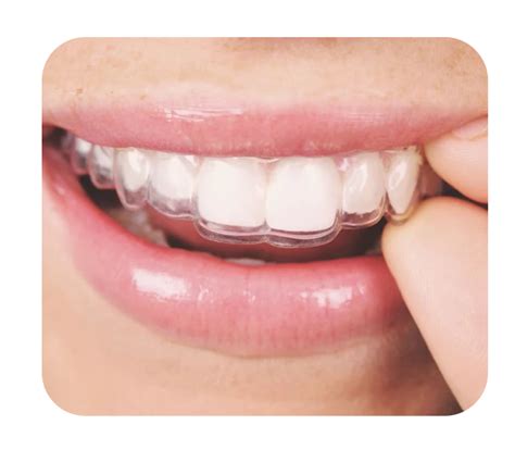 What are Clear Aligners? | Veristic Aligners