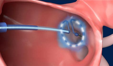 Pulsed Field Ablation Effective Against Paroxysmal Atrial Fibrillation ...