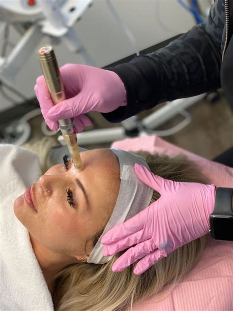 Microneedling / Microneedling Results / Nashville Microneedling | Skin
