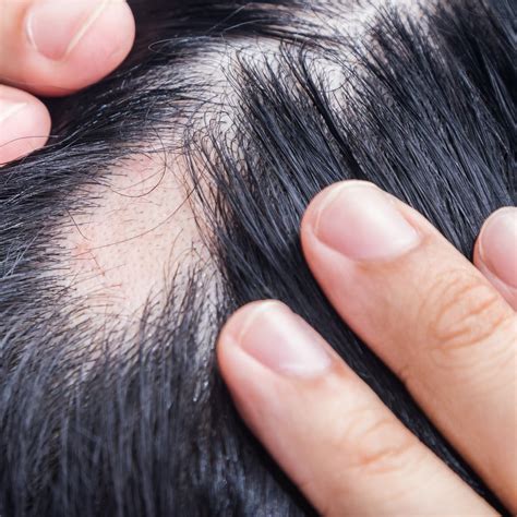 understanding   types  hair loss ds laboratories