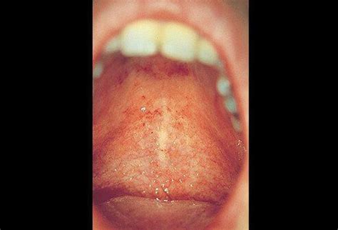 Forchheimer Spots in Rubella - MEDizzy