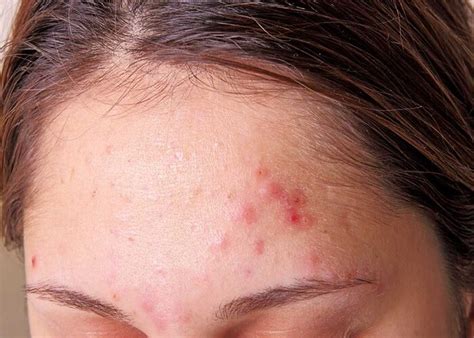 Pimples on the forehead: causes and treatment - Fastlyheal