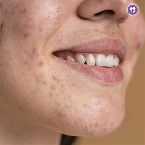 Acne (Pimples) Treatment at RootCosmo