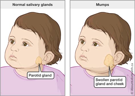 Mumps outbreaks in Kerala: What you should know about Mumps ...