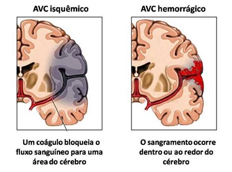 Fisioblogando: Acidente Vascular Cerebral (AVC)