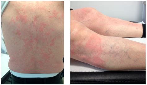 treatment  patients  monoclonal gammopathy  clinical significance