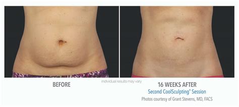 CoolSculpting before and after | Real Patient Photos - Vein & Laser ...
