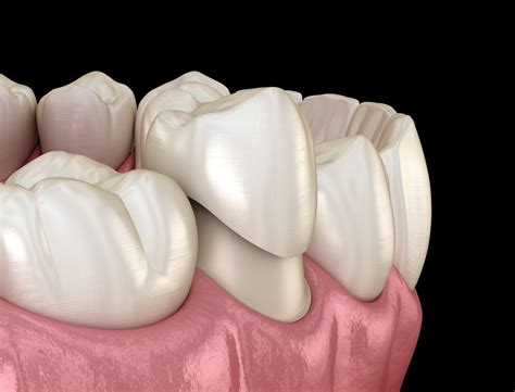 Dental Crowns - Family Dental Centres