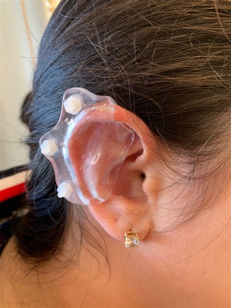 Custom Plastic Ear Compression for Keloids Pressure Earring | Etsy