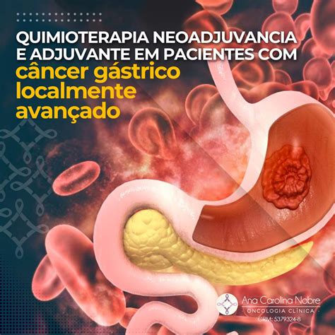 Adjuvante E Neoadjuvante - Quimioterapia neoadjuvante e adjuvante em pacientes com câncer gastrico ...