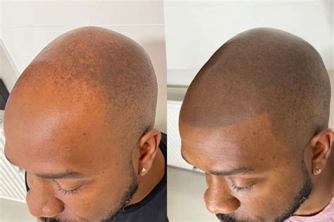 scalp micropigmentation alopecia areata totalis blade smp