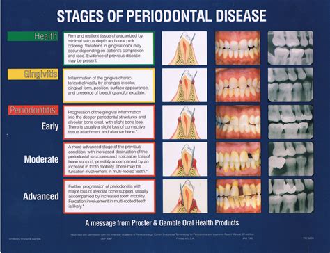 Periodontal Disease And How it Affects Your Health - Victor Valley News