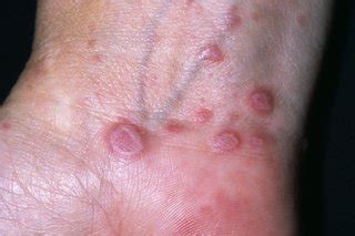 Lichen Sclerosus On Legs