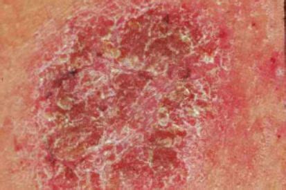 dry skin symptoms treatments dermatology skin cancer conditions