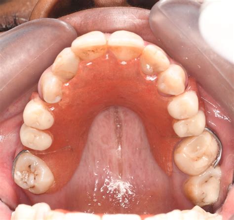 Case Study: Implants and Veneers Procedure. Anterior&Posterior