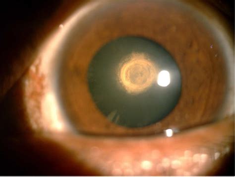 Posterior Subcapsular Cataracts: Signs, Causes And Treatments