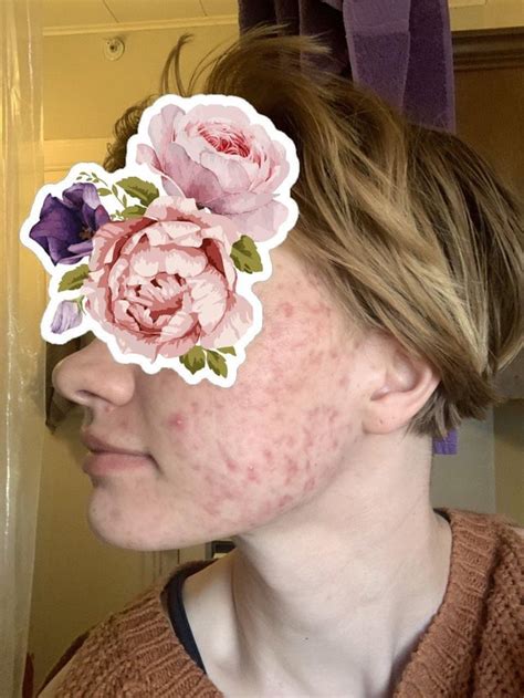 [Acne] Resurfacing Scars : r/AcneScars