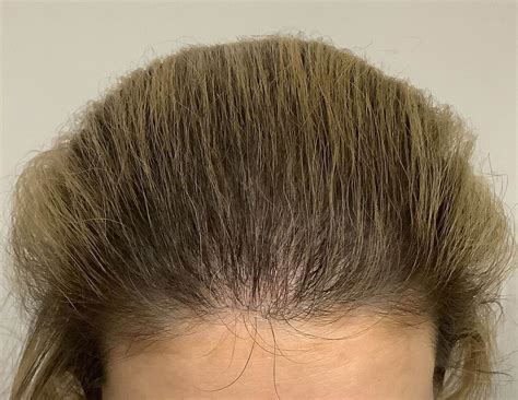 Female Results - Miami Hair Institute