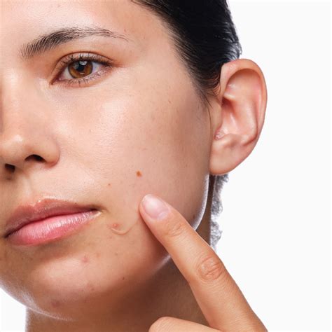 acne set salicylic acid  regimen  clear skin