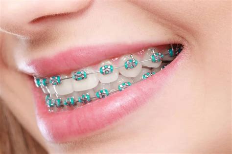 Braces Cyberjaya - Karimah Dental