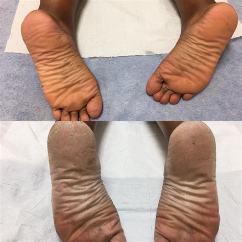 Foot And Callus Peel at Mary Sims blog