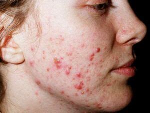 acne vulgaris physiopedia