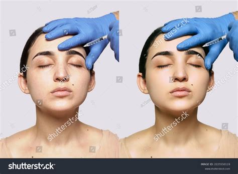 Womans Face Before After Plastic Surgery Stock Photo 2225550119 ...