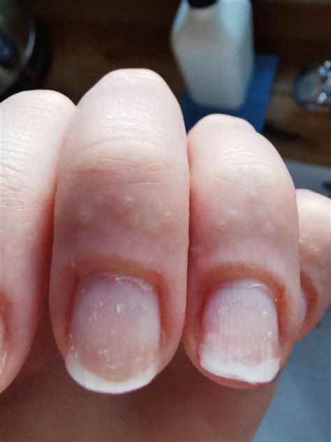 Allergic reaction to at-home gel polish, photos after first and second application :( : r/Nails