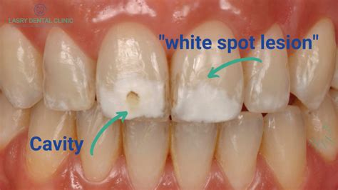 Do You Have a Cavity? Cavities Stages & What They Look Like