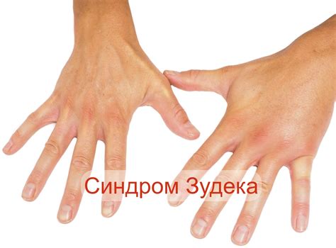 Синдром запястного канала симптомы, лечение, упражнения